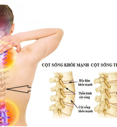 THOÁI HOÁ CỘT SỐNG : TRIỆU CHỨNG, NGUYÊN NHÂN VÀ GIẢI PHÁP 