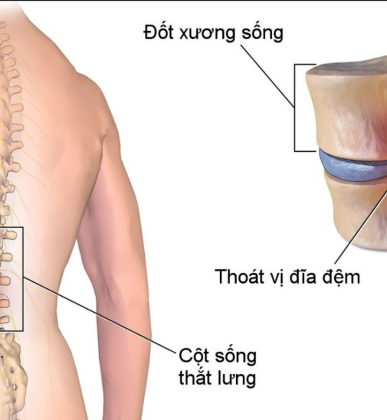 THOÁT VỊ ĐĨA ĐỆM : TRIỆU CHỨNG, NGUYÊN NHÂN VÀ GIẢI PHÁP 